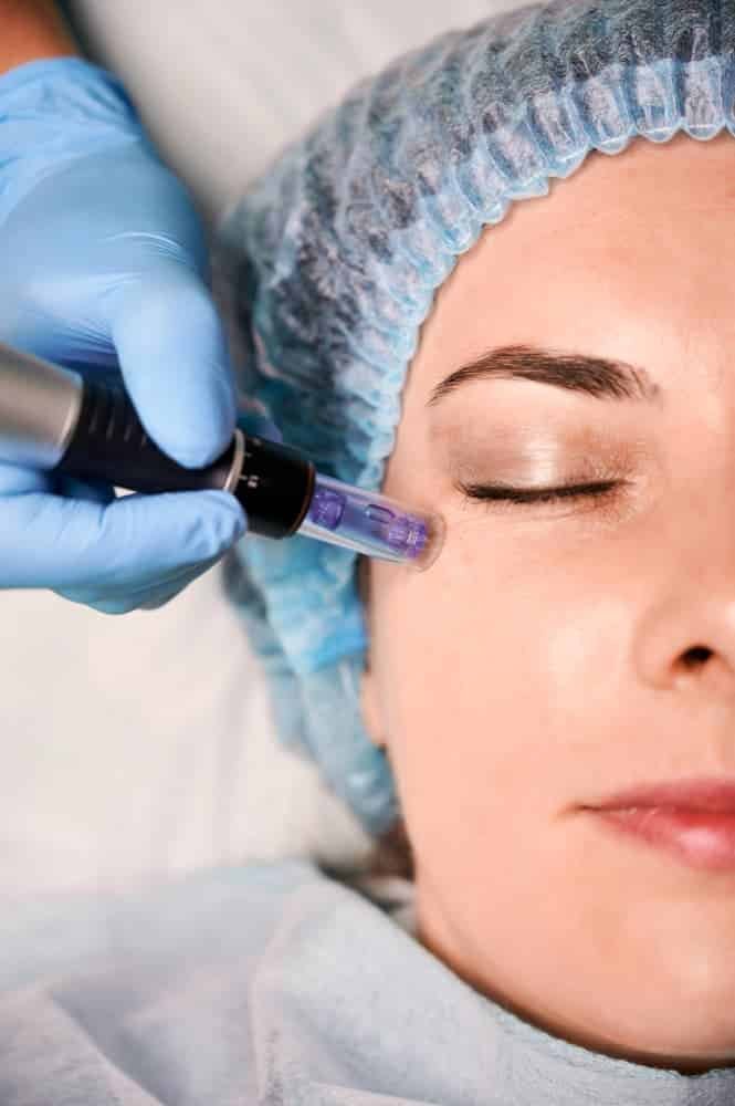 Microneedling dermapen Zaragoza
